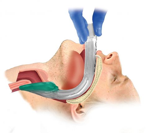 I-Gel Airway - WEB-IGA , 